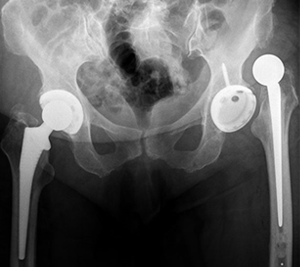 Failed hip replacements