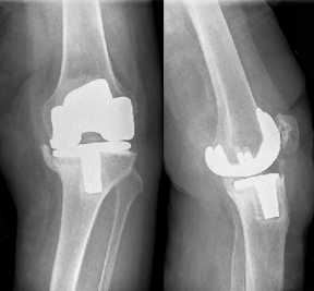 Failed knee replacements